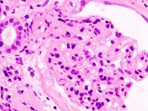 Histopathological image of diabetic glomerulosclerosis with nephrotic syndrome