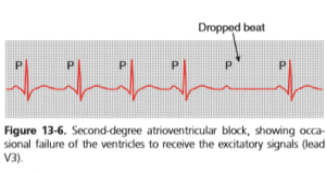 Second degree heart block