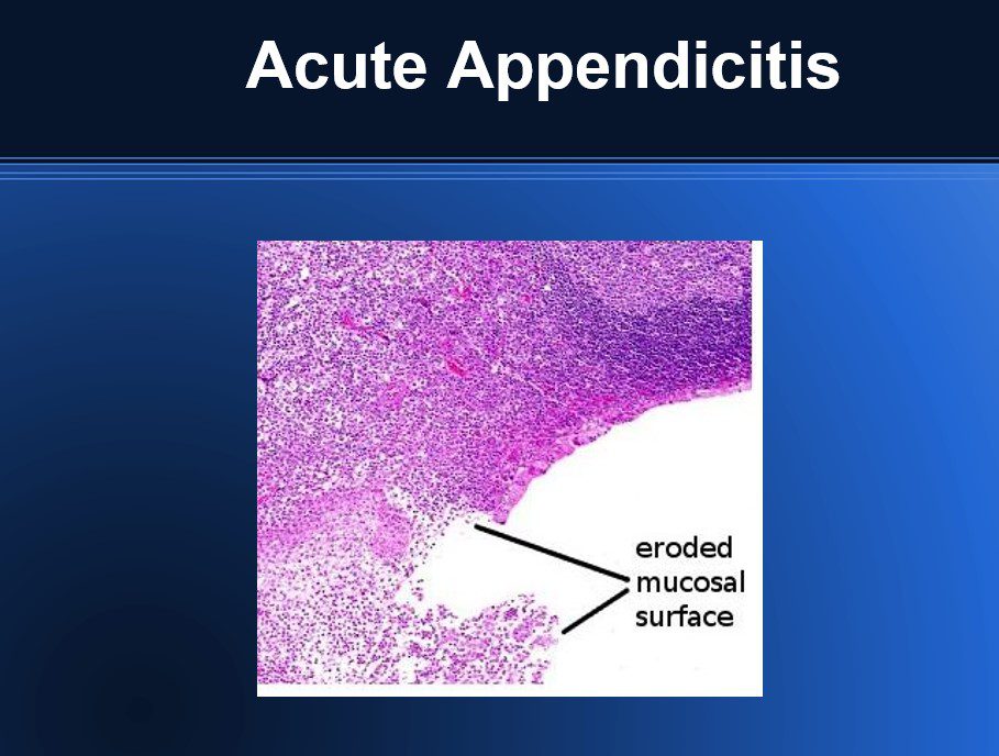 Pathology of Acute Appendicitis - Its Etiology, Morphology, Gross Appearance & Microscopic view