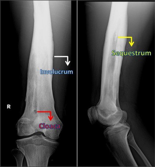 What is Sequestrum Involucrum?