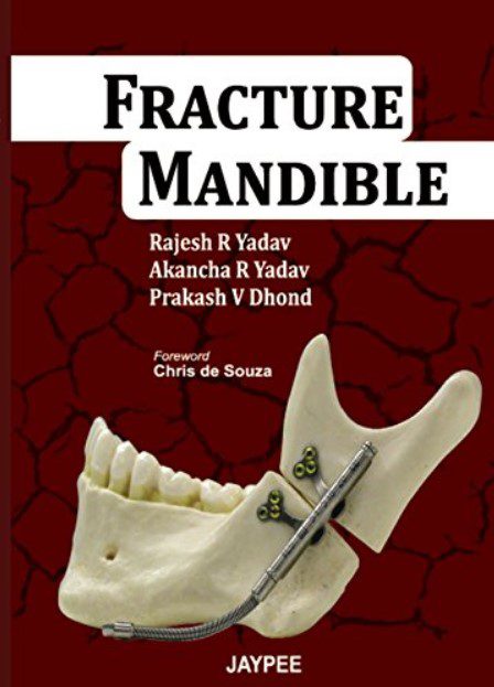 Fracture Mandible by Rajesh R Yadav PDF Free Download