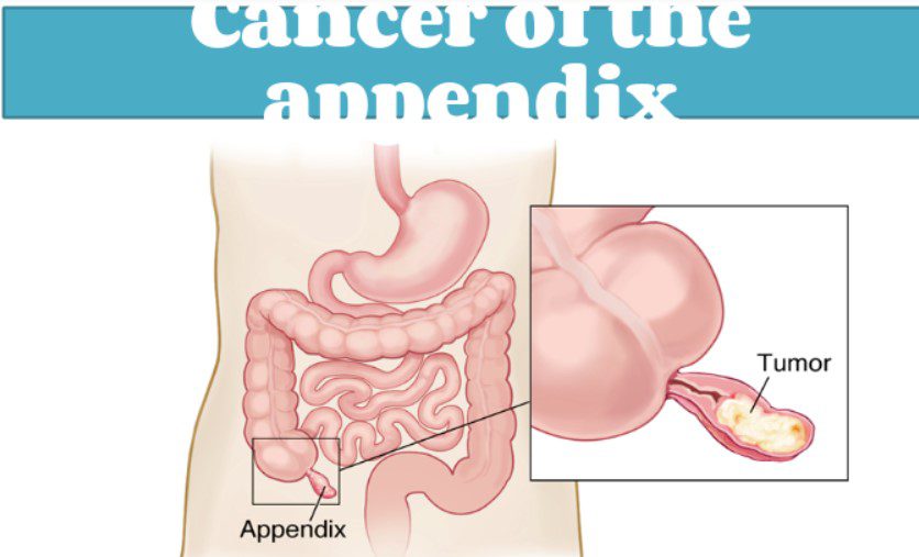 Cancer of the Appendix All the basics PDF Free Download