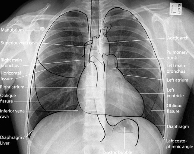 Understanding Basics of Reading Chest X-ray