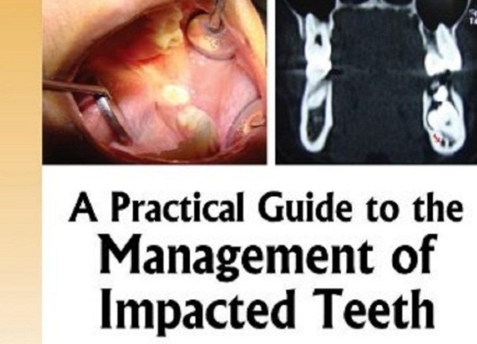 A Practical Guide to the Management of Impacted Teeth PDF Free Download