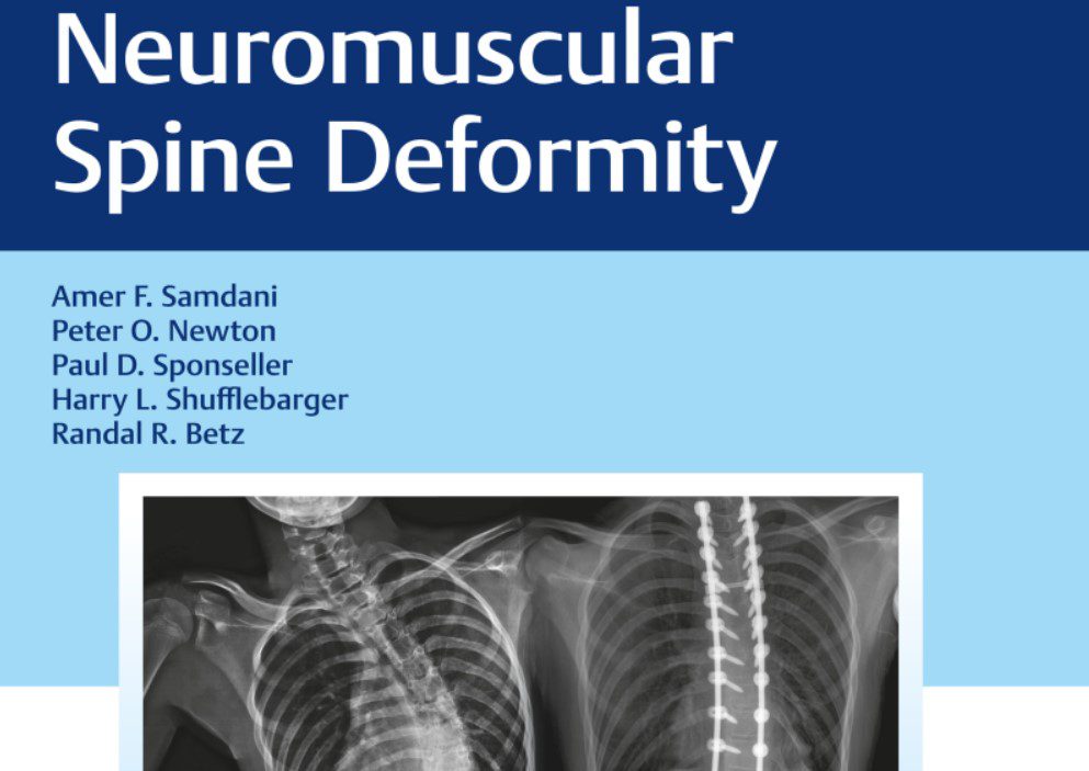 Neuromuscular Spine Deformity 1st Edition PDF Free Download