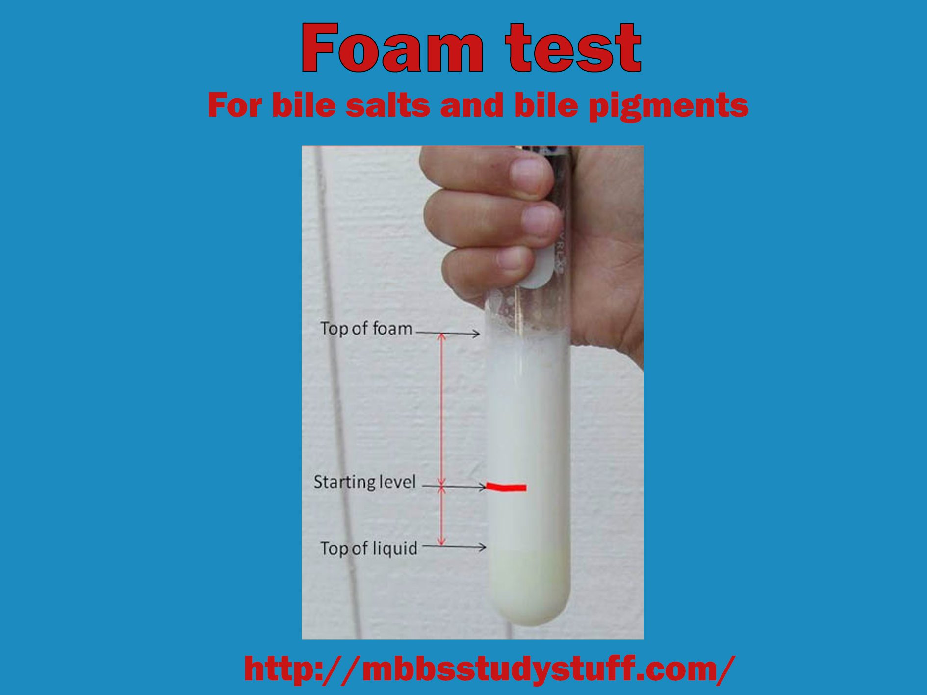 Foam test for bile salts and bile pigments