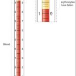 Method Determine of Erythrocyte Sedimentation Rate (ESR) 