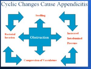 Pathology of Acute Appendicitis - Its Etiology, Morphology, Gross ...