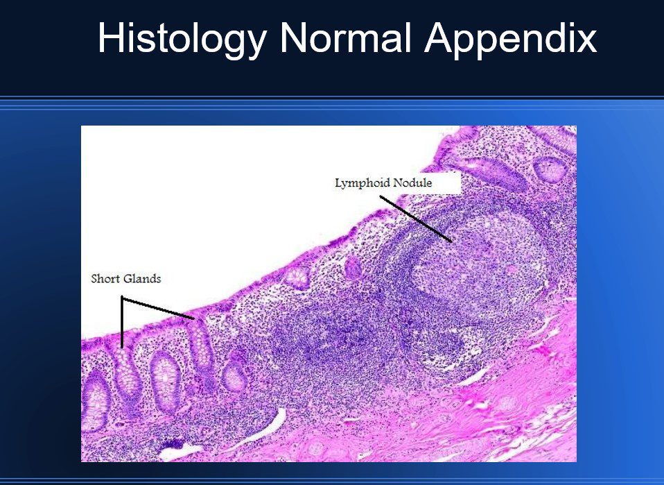 Acute Appendicitis Histology Diagram