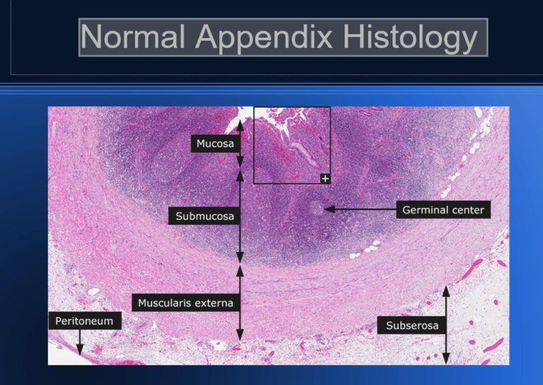 Pathology Of Acute Appendicitis - Its Etiology, Morphology, Gross 