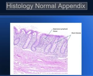 Pathology of Acute Appendicitis - Its Etiology, Morphology, Gross ...