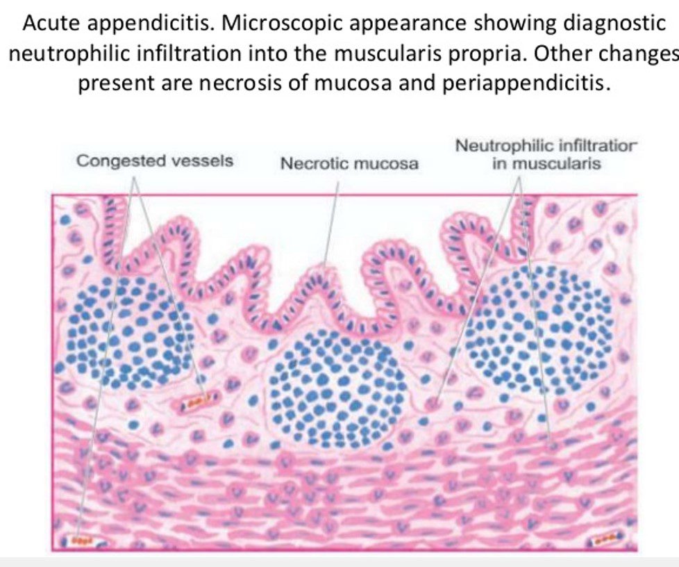 Histopathology Acute Appendicitis BRSGY Histopathology Acute Appendicitis BRSGY