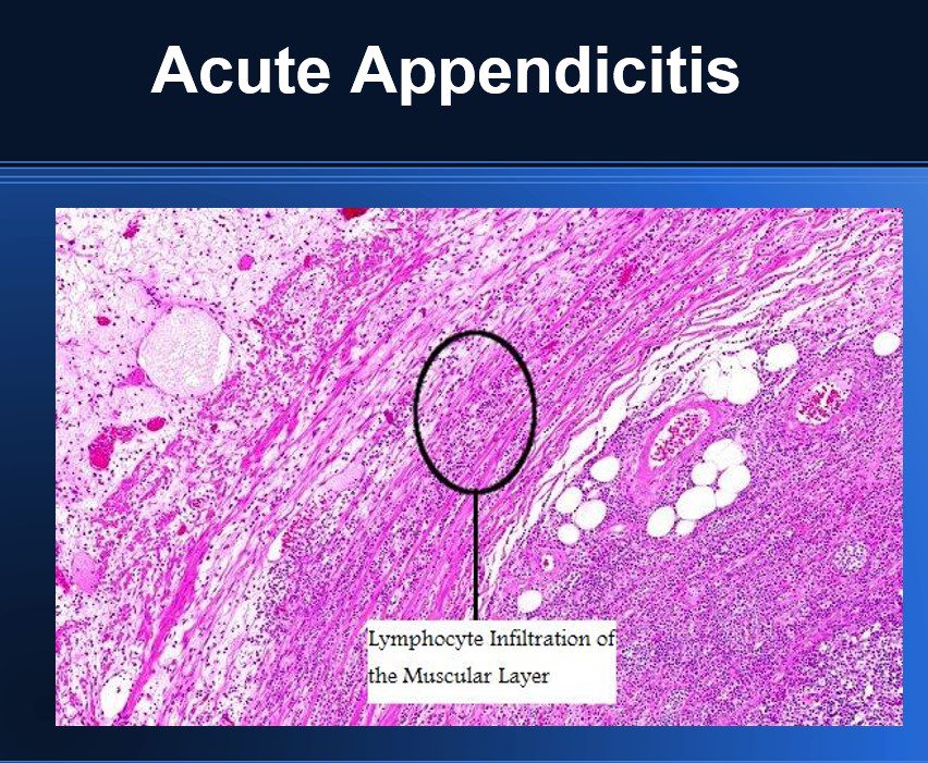 Acute Appendicitis Slide Drawing Acute Appendicitis – Ecosdeltorbes