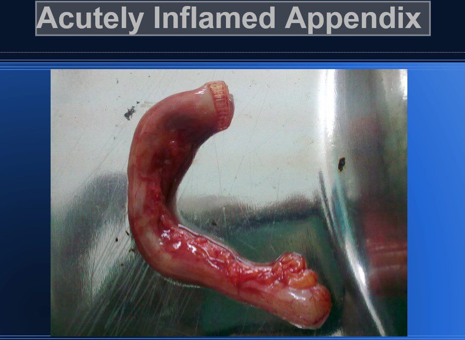 Pathology of Acute Appendicitis - Its Etiology, Morphology, Gross Appearance & Microscopic view