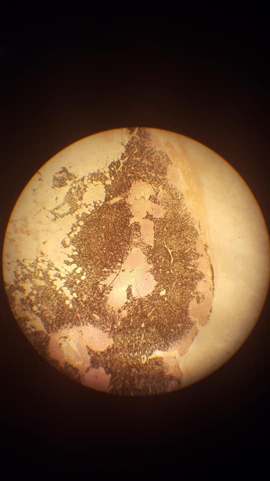 Anthracosis Slide with Points of Identification