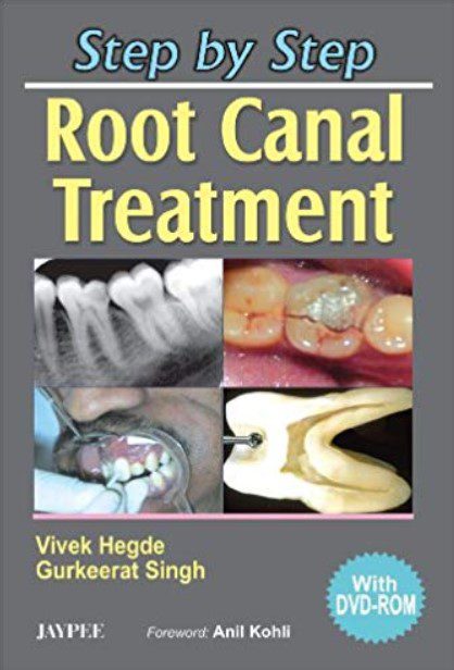 Step by Step Root Canal Treatment PDF Free Download