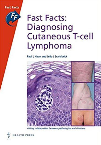 Download Fast Facts: Diagnosing Cutaneous T-cell Lymphoma 1st Edition PDF Free