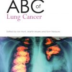 ABC of Lung Cancer PDF Free Download