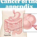 Cancer of the Appendix All the basics PDF Free Download