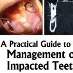 A Practical Guide to the Management of Impacted Teeth PDF Free Download