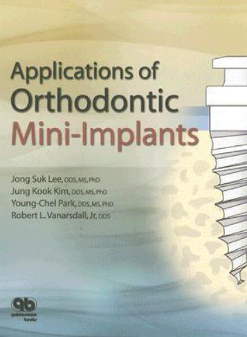 Applications of Orthodontic Mini-Implants PDF Free Download