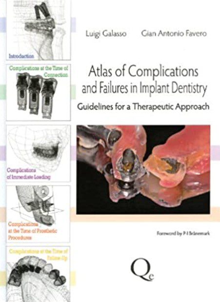 Atlas of Complications and Failures in Implant Dentistry PDF Free Download