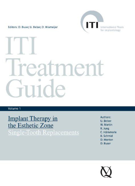 ITI Treatment Guide Volume 1 PDF Free Download