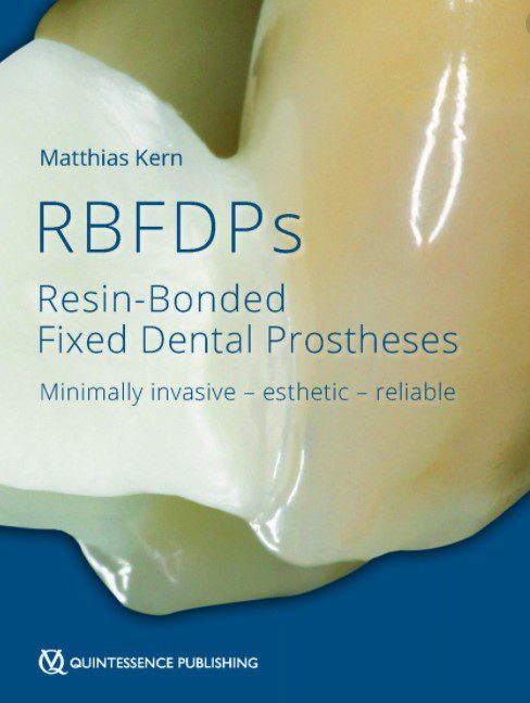 RBFDPs Resin Bonded Fixed Dental Prosthesis PDF Free Download