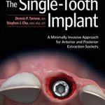 The Single Tooth Implant PDF Free Download