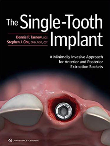 The Single Tooth Implant PDF Free Download