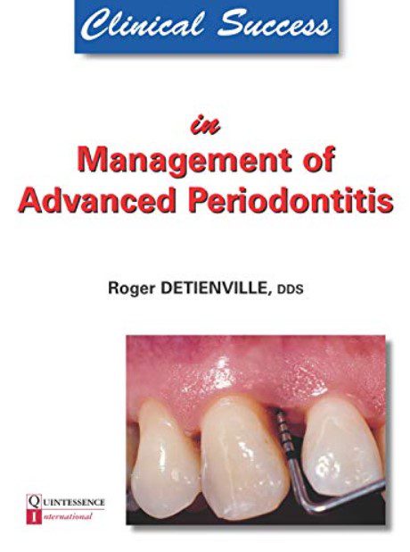 Clinical Success in Management of Advanced Periodontitis PDF Free Download