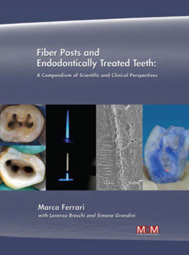 Fiber Posts and Endodontically Treated Teeth PDF Free Download