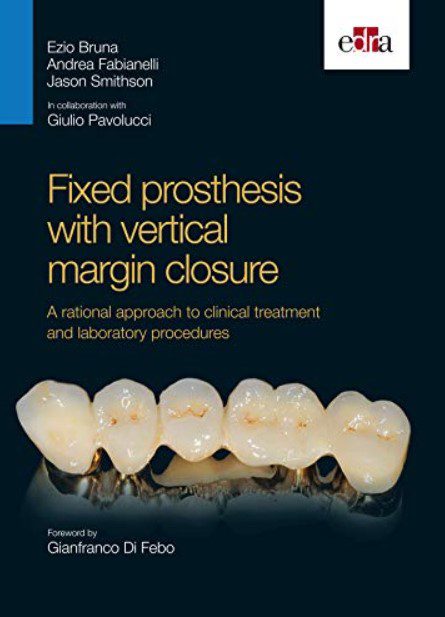 Fixed prosthesis with vertical margin closure PDF Free Download