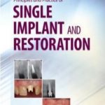 Principles and Practice of Single Implant and Restoration PDF Free Download
