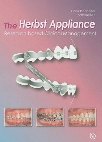The Herbst Appliance: Research-Based Clinical Management PDF Free Download