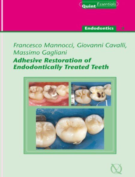 Adhesive Restoration of Endodontically Treated Teeth PDF Free Download