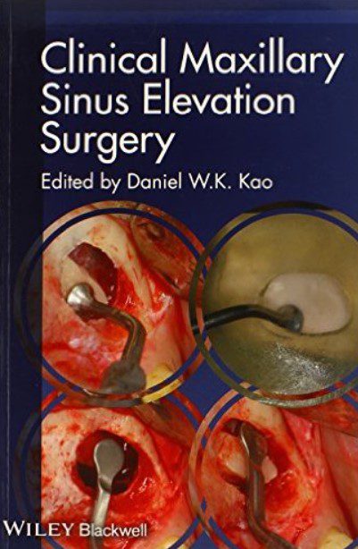 Clinical Maxillary Sinus Elevation Surgery PDF Free Download