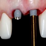 Online Residency Program: A-Z in Implant Dentistry 2021 Videos Free Download