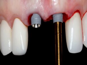 Online Residency Program: A-Z in Implant Dentistry 2021 Videos Free Download