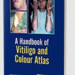 A Handbook of Vitiligo and Colour Atlas by SK Punshi PDF Free Download