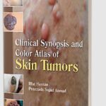 Clinical Synopsis and Color Atlas of Skin Tumors by Iffat Hassan PDF Free Download
