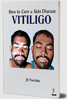 How to Cure a Skin Disease: Vitiligo by JS Pasricha PDF Free Download