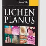 Lichen Planus by Uday Khopkar PDF Free Download