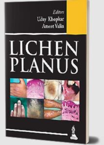 Lichen Planus by Uday Khopkar PDF Free Download
