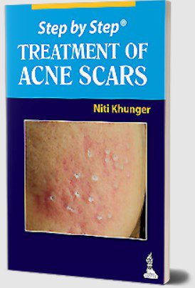 Treatment of Acne Scars by Niti Khunger PDF Free Download