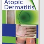 Atopic Dermatitis by Satish Udare PDF Free Download
