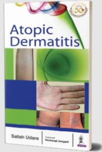 Atopic Dermatitis by Satish Udare PDF Free Download