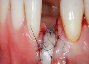 Download gIDEdental Soft Tissue Management around Natural Teeth and Dental Implants 2020 Videos Free