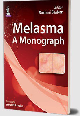 Melasma: A Monograph by Rashmi Sarkar PDF Free Download