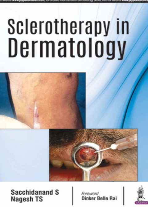 Sclerotherapy in Dermatology by Sacchidanand S PDF Free Download